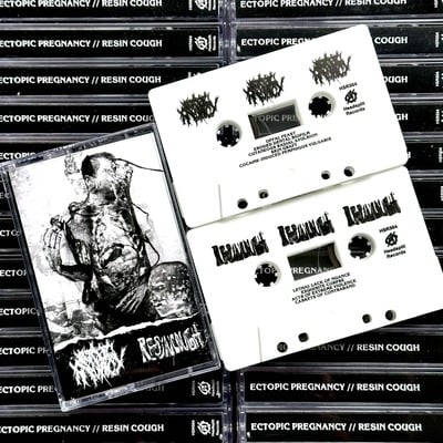 Ectopic Pregnancy / Resin Cough split cassette