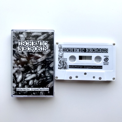 Ischemic Necrosis - “Cadaveric Liquefaction”