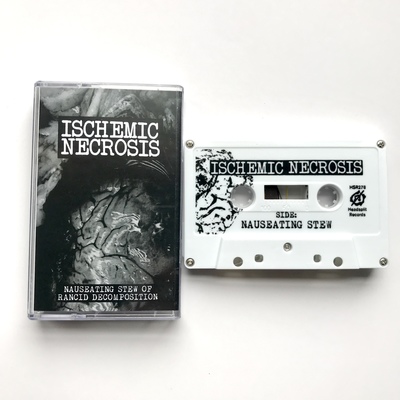 Ischemic Necrosis - "Nauseating Stew of Rancid Decomposition"