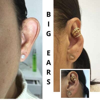 Accessory to beautify large ears