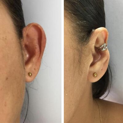 Accessory to beautify large ears