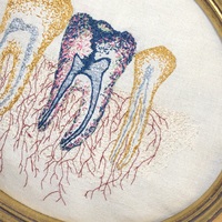 Wisdom Teeth - Thumbnail 4