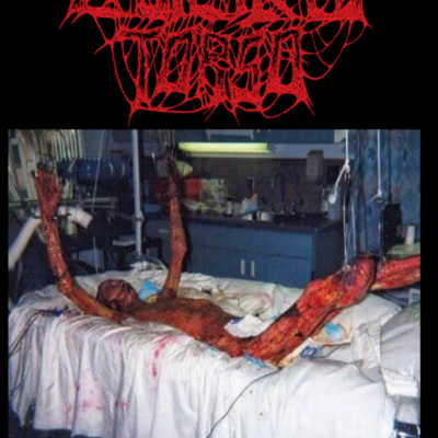 Cauterized torso - "painless disfigurement"