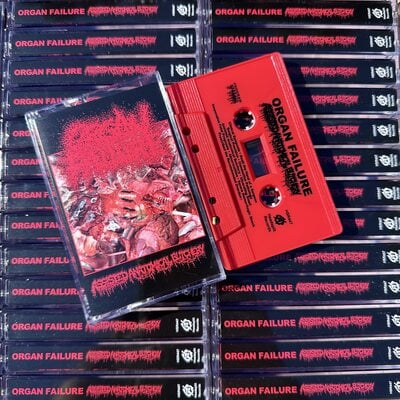 Organ failure - "assisted anatomical butchery" cassette