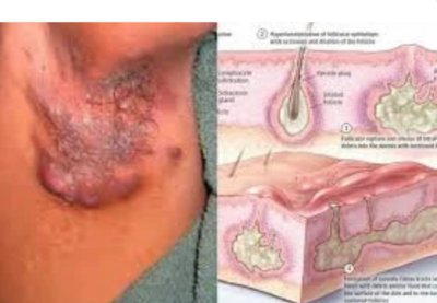  Hidradenitis Suppurativa Cream | HS Relief Cream