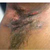  Hidradenitis Suppurativa Cream | HS Relief Cream - Thumbnail 1