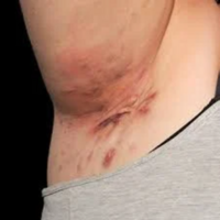  Hidradenitis Suppurativa Cream | HS Relief Cream - Thumbnail 2