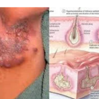  Hidradenitis Suppurativa Cream | HS Relief Cream - Thumbnail 4