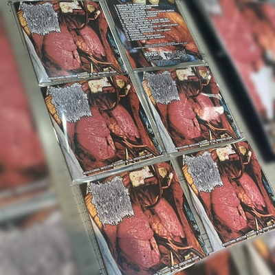 Nosocomial infection acquired in the operating room - congestive gastropathy (cd-r)