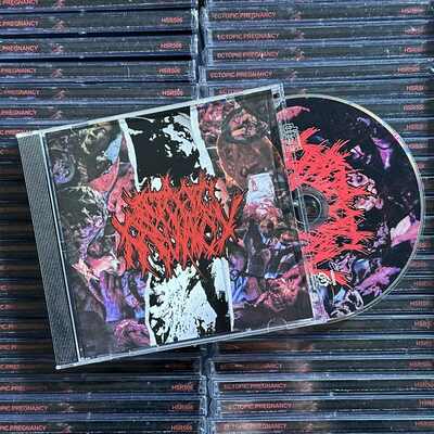 Ectopic pregnancy discography cd