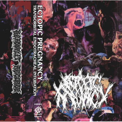 Ectopic pregnancy - "transorbital endotracheal intubation" cassette