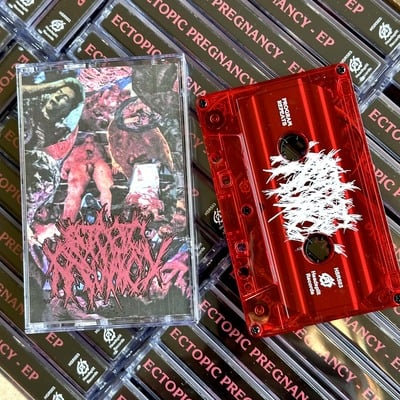 Ectopic pregnancy - s/t ep cassette