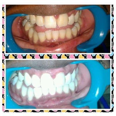Laser teeth whitening