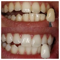 Laser teeth whitening - Thumbnail 1